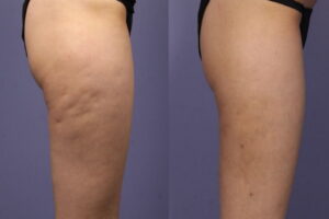 se debarrasser de la cellulite