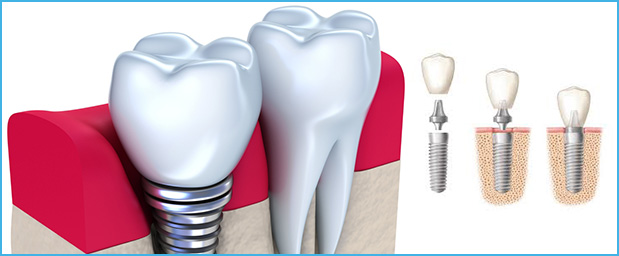 Implants dentaires en Tunisie