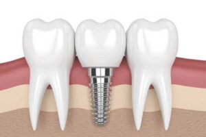 Implants dentaires prix