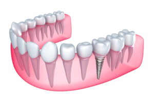 mise en place des implants dentaires