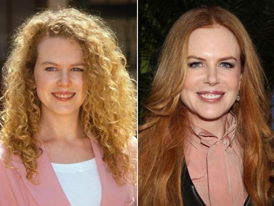 Nicole Kidman Chirurgie Esthétique Avant Après