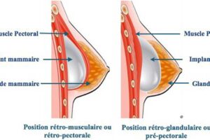 position des prothèses mammaires