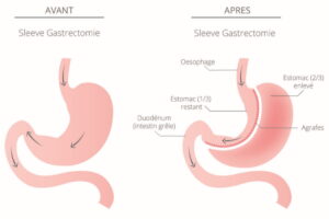 sleeve gastrique avant apres