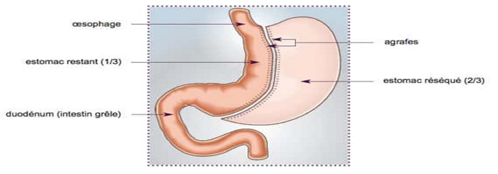 avantages et risques de la sleeve gastrique