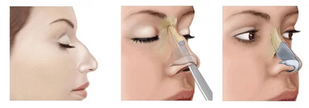 Combien coûte une rhinoplastie