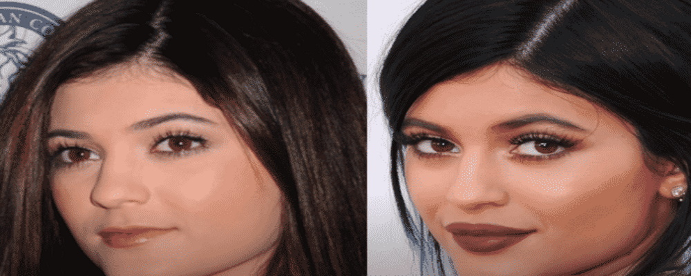 Kylie Jenner avant chirurgie