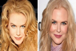 Nicole Kidman chirurgie esthetique