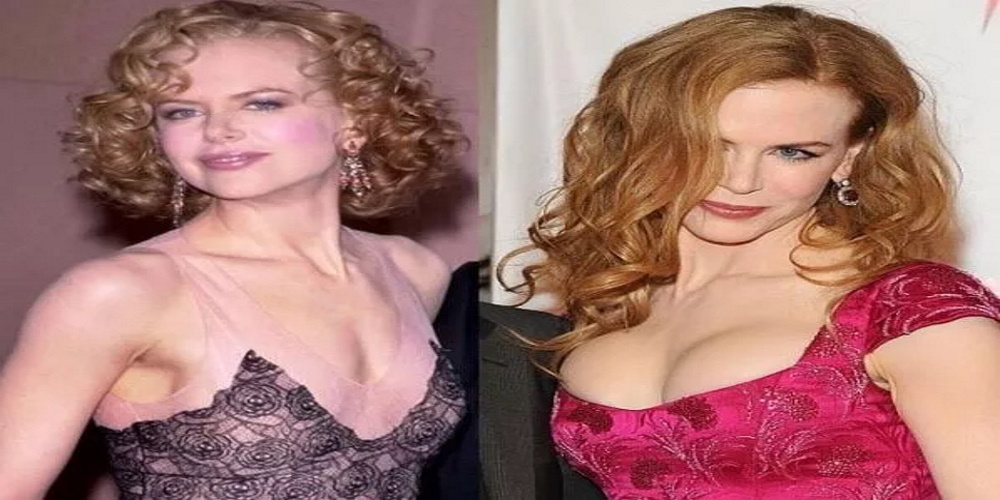 Nicole Kidman Chirurgie des seins