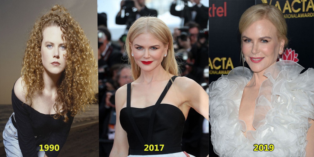Nicole Kidman avant après chirurgie du nez