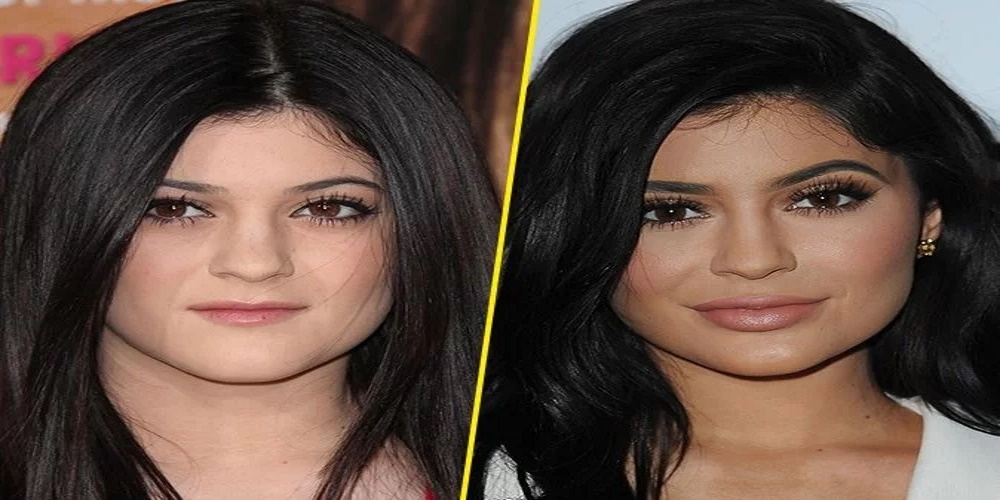 kylie jenner avant apres chirurgie esthetique