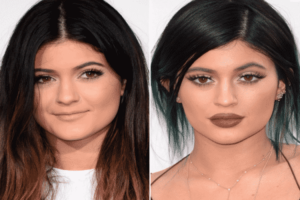 kylie jenner avant chirurgie