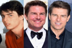 tom cruise chirurgie esthetique