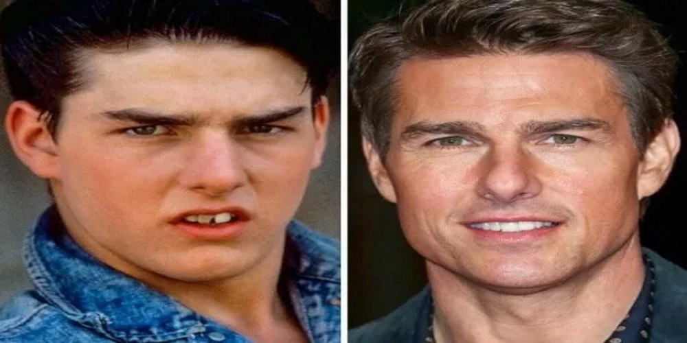 Tom Cruise Avant après la chirurgie esthétique des dents