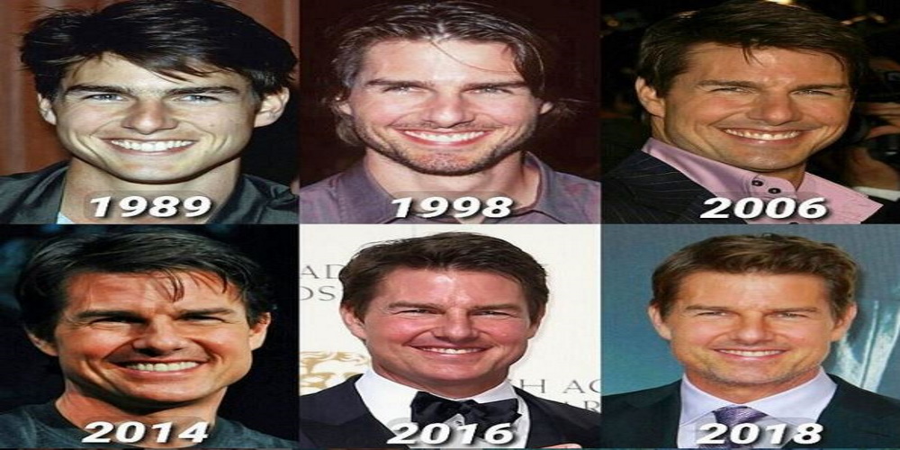 Transformation Tom Cruise avant après la chirurgie esthétique
