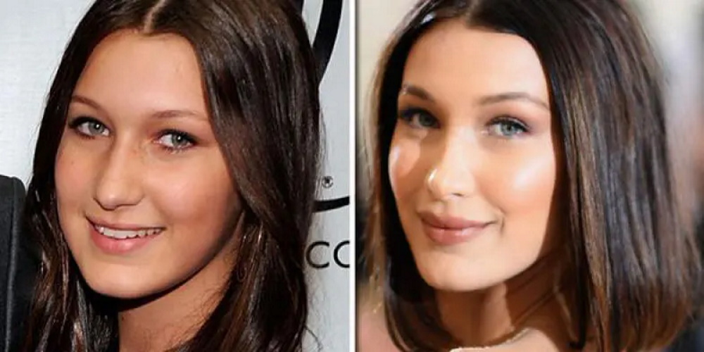 Bella Hadid avant apres