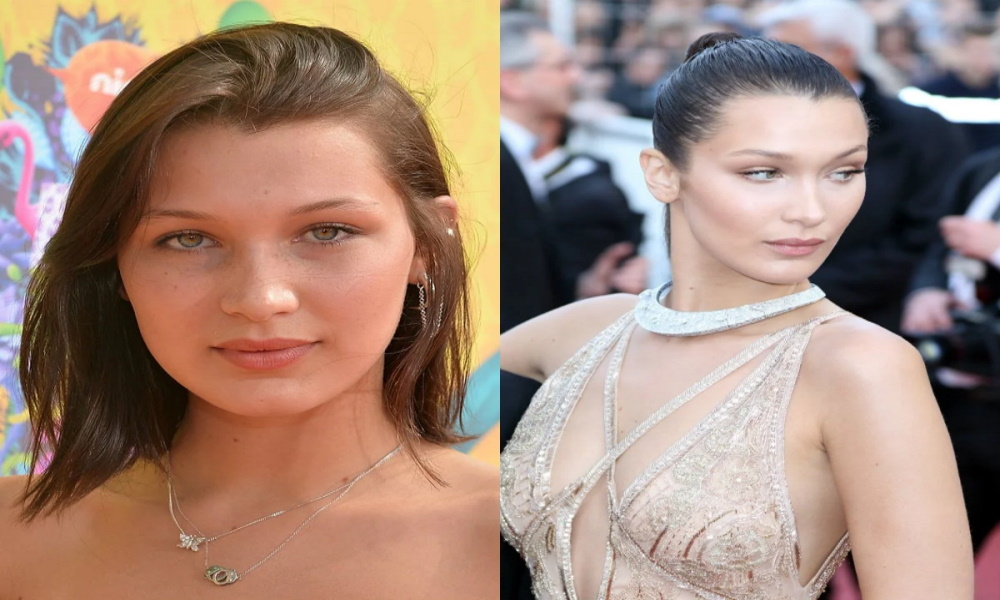 Bella Hadid rhinoplastie