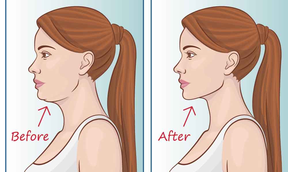 jawline contouring avant après