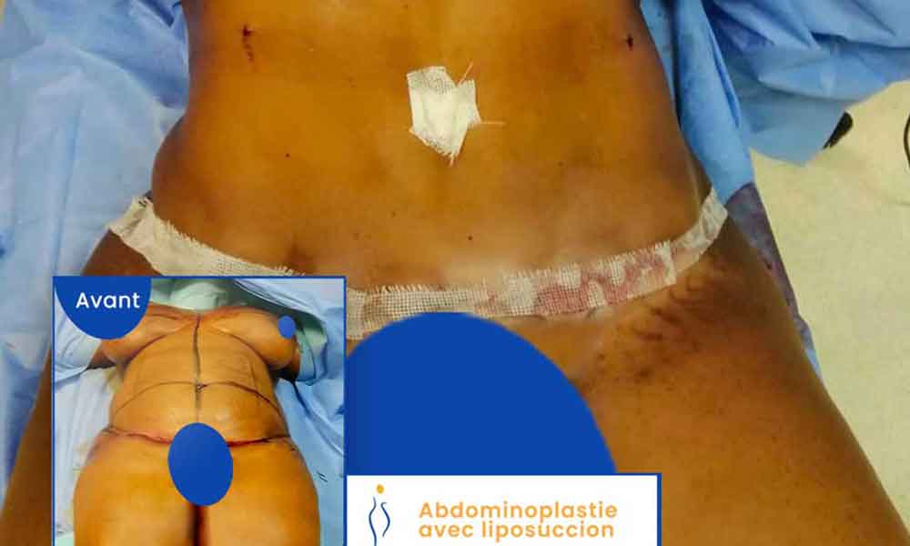 liposuccion abdominale