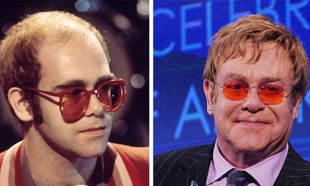 elton john greffe de cheveux