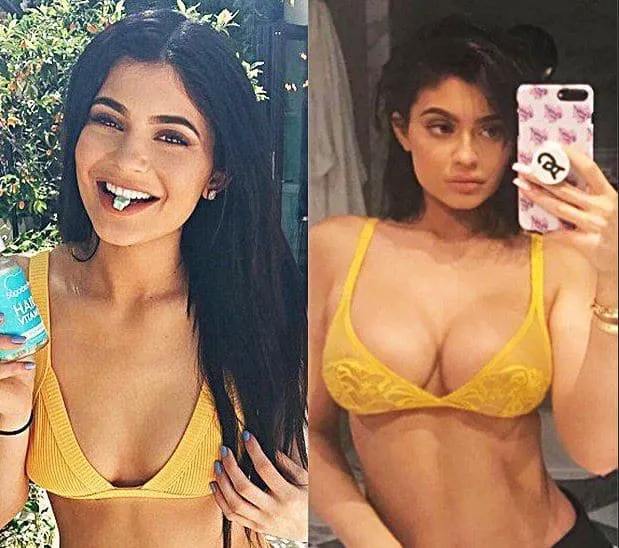 Kylie Jenner chirurgie de la poitrine est évidente