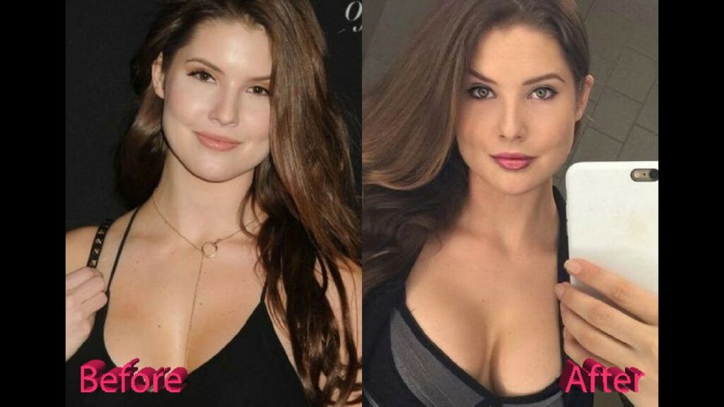 Amanda Cerny avant/ après la chirurgie esthétique 