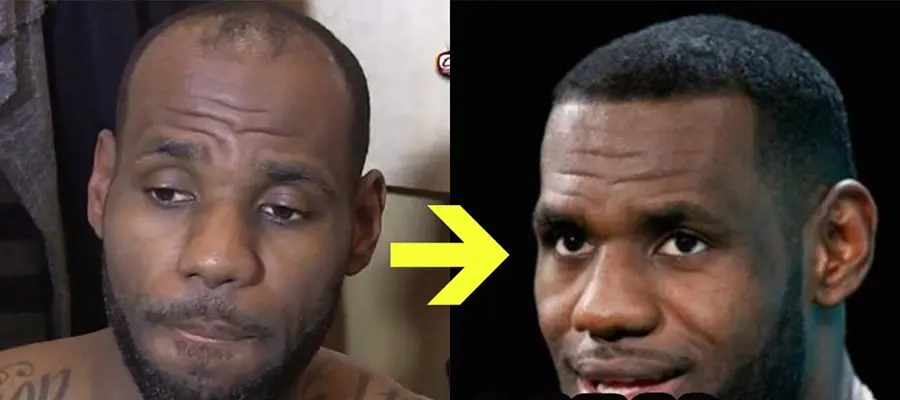 LeBron a-t-il subi une greffe de cheveux ?