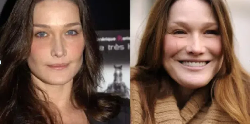 Carla Bruni avant après chirurgie esthétique