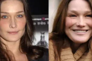 Carla Bruni avant après chirurgie esthétique