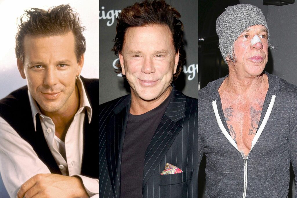 chirurgie esthétique mickey rourke