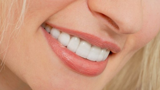 ceramic dental veneers