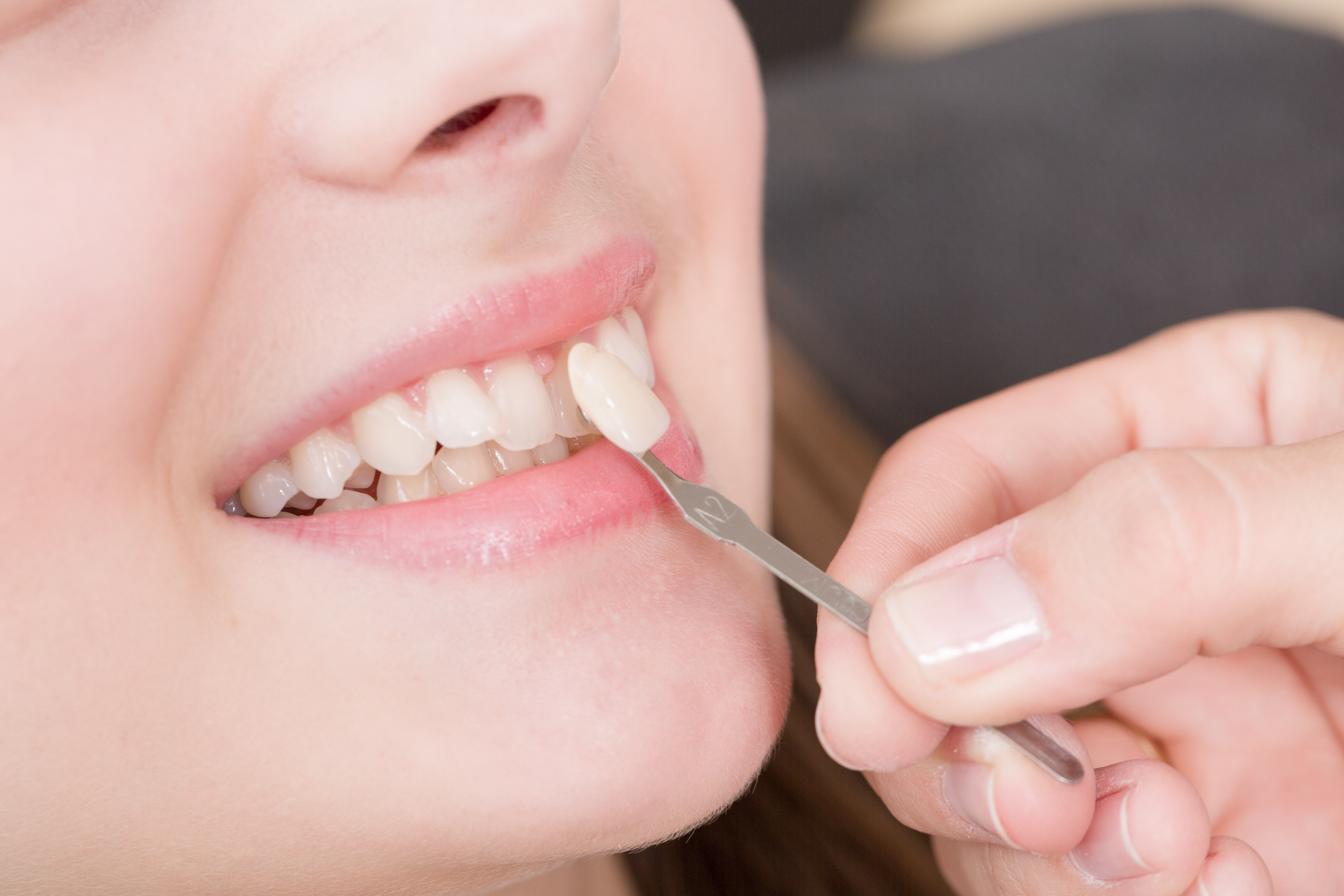 Dental veneers Tunisia