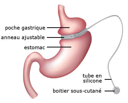 gastric band surgery in tunisia
