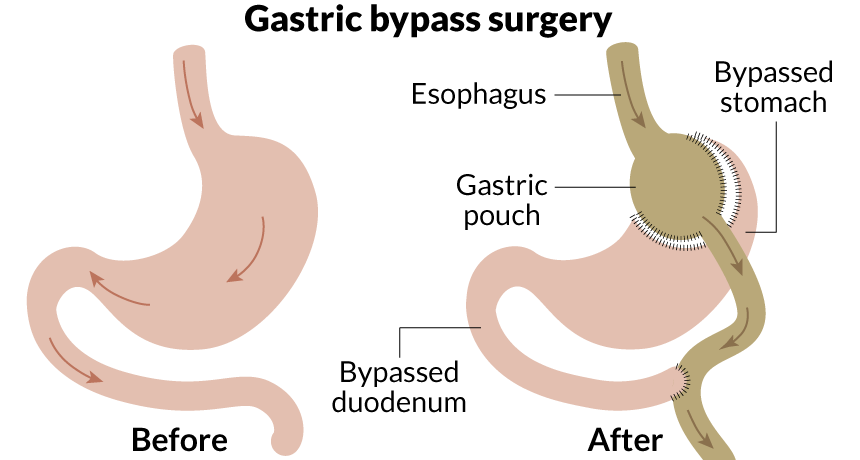 Gastric Bypass in tunisia