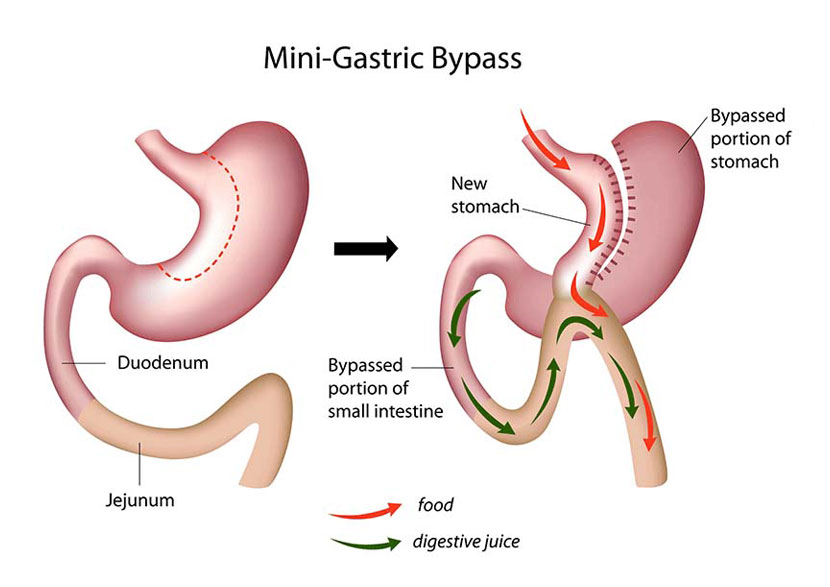 gastric bypass surgery in tunisia