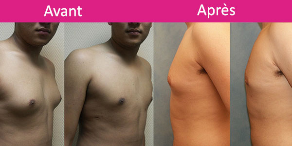 gynecomastia before and after