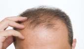 hair transplant tunisia