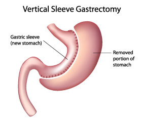 Tunisia Sleeve gastric