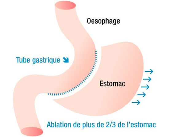 Tunisia Sleeve gastrectomy