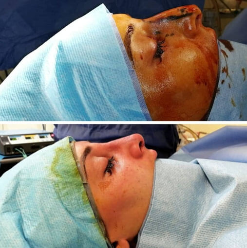 rhinoplastie tunisie avant après