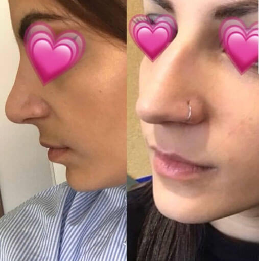 rhinoplastie avant apres tunisie