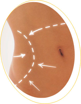 abdominoplastie tunisie