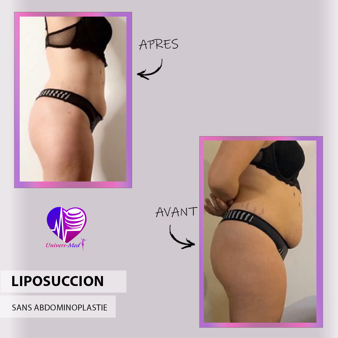 liposuccion ventre avant après tunisie