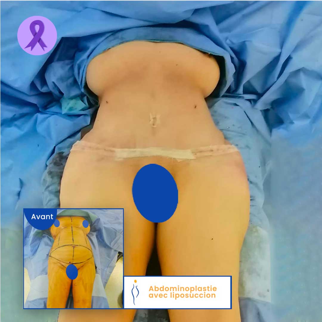 Abdominoplastie avant et après