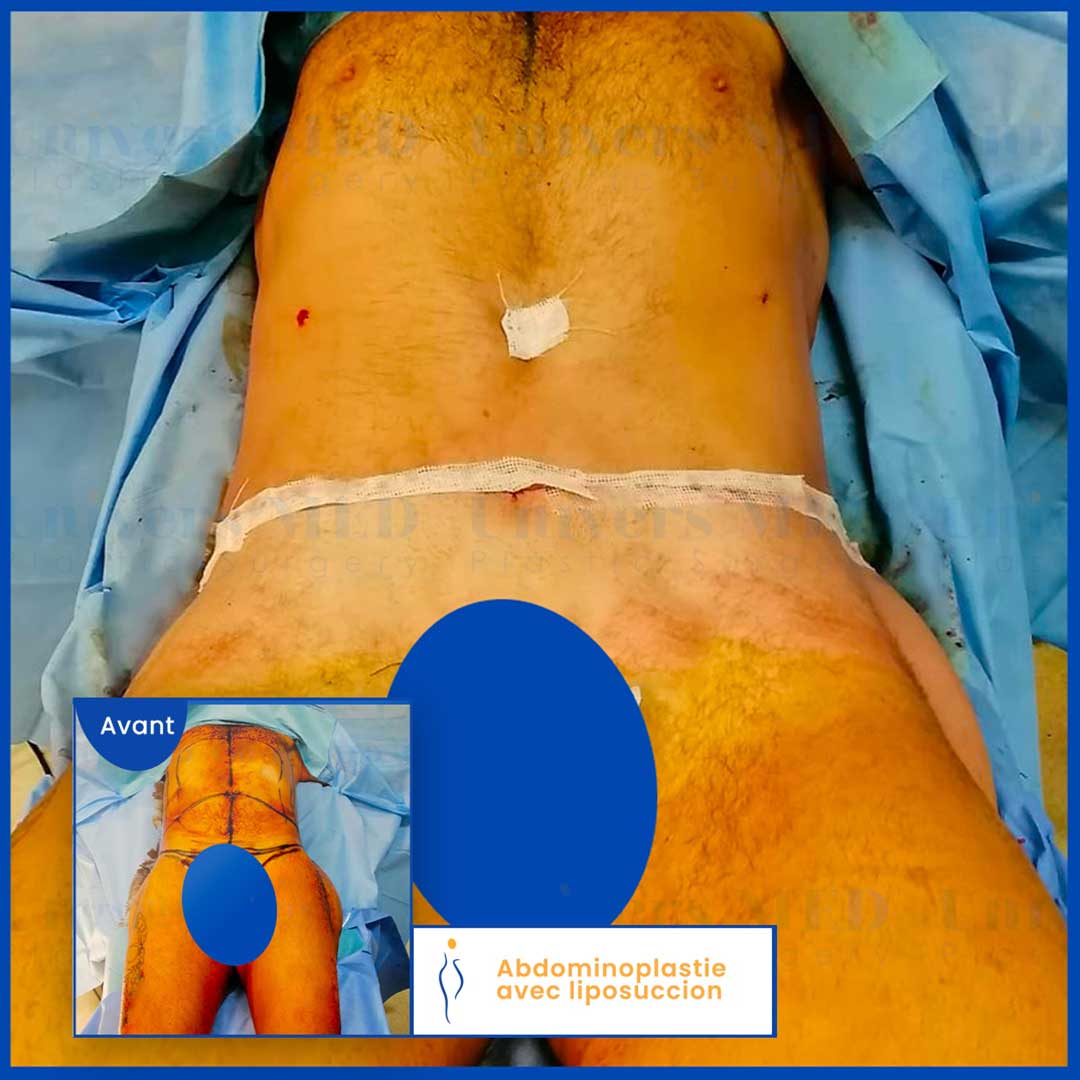 Abdominoplastie avant après homme