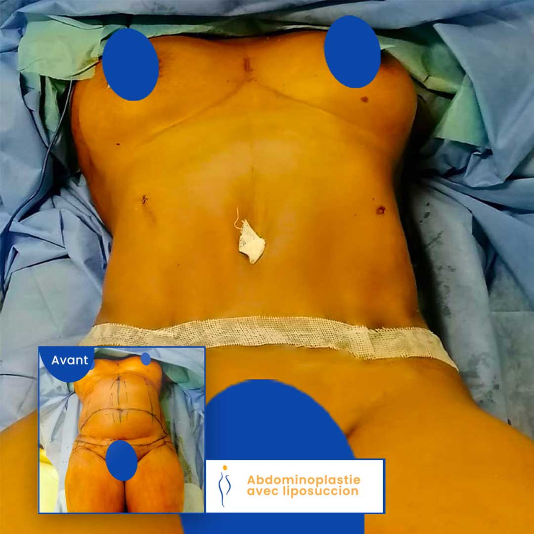 Abdominoplastie j plasma ventre avant après