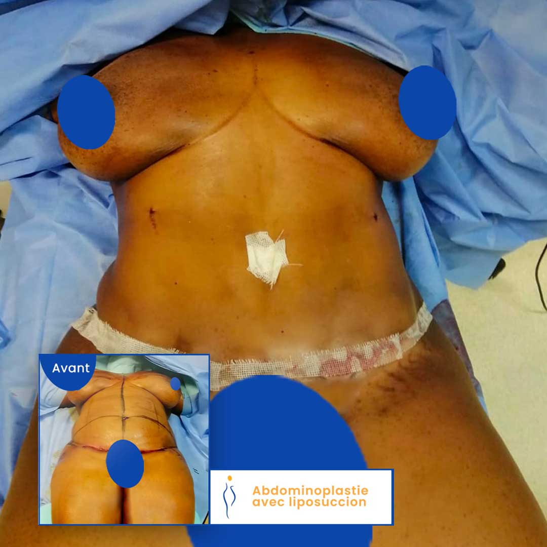 abdominoplastie avant après femme