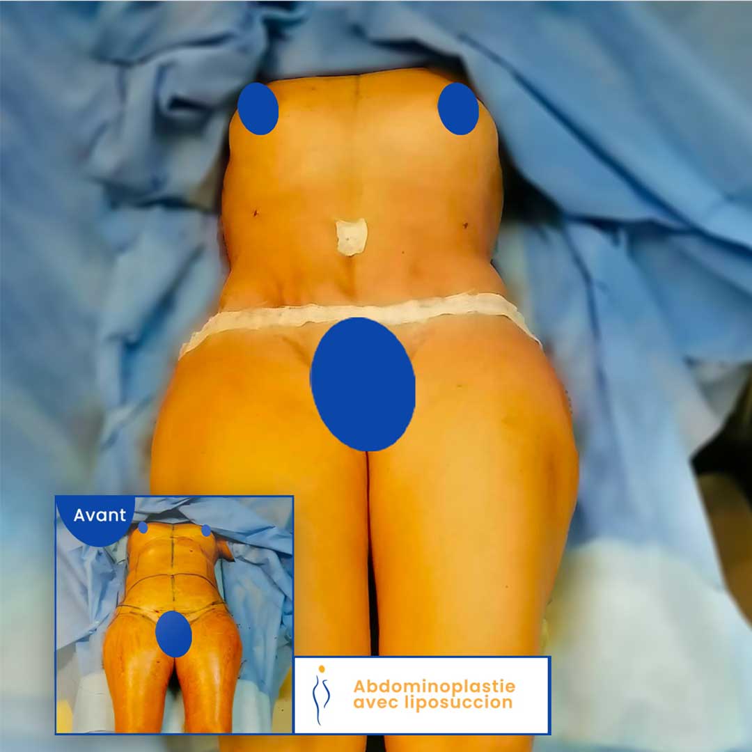 avant après abdominoplastie