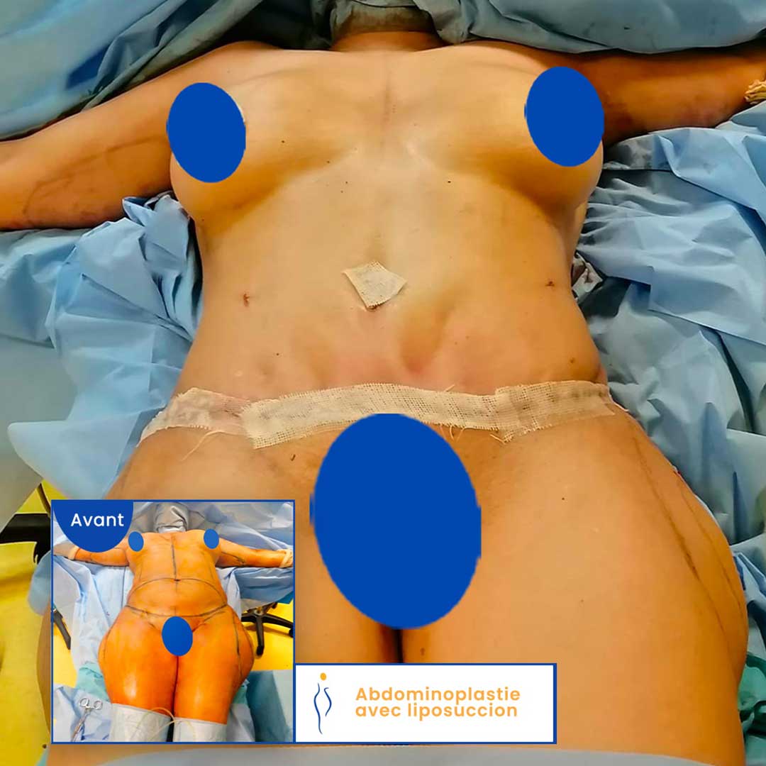 abdominoplastie avant après femme et liposuccion