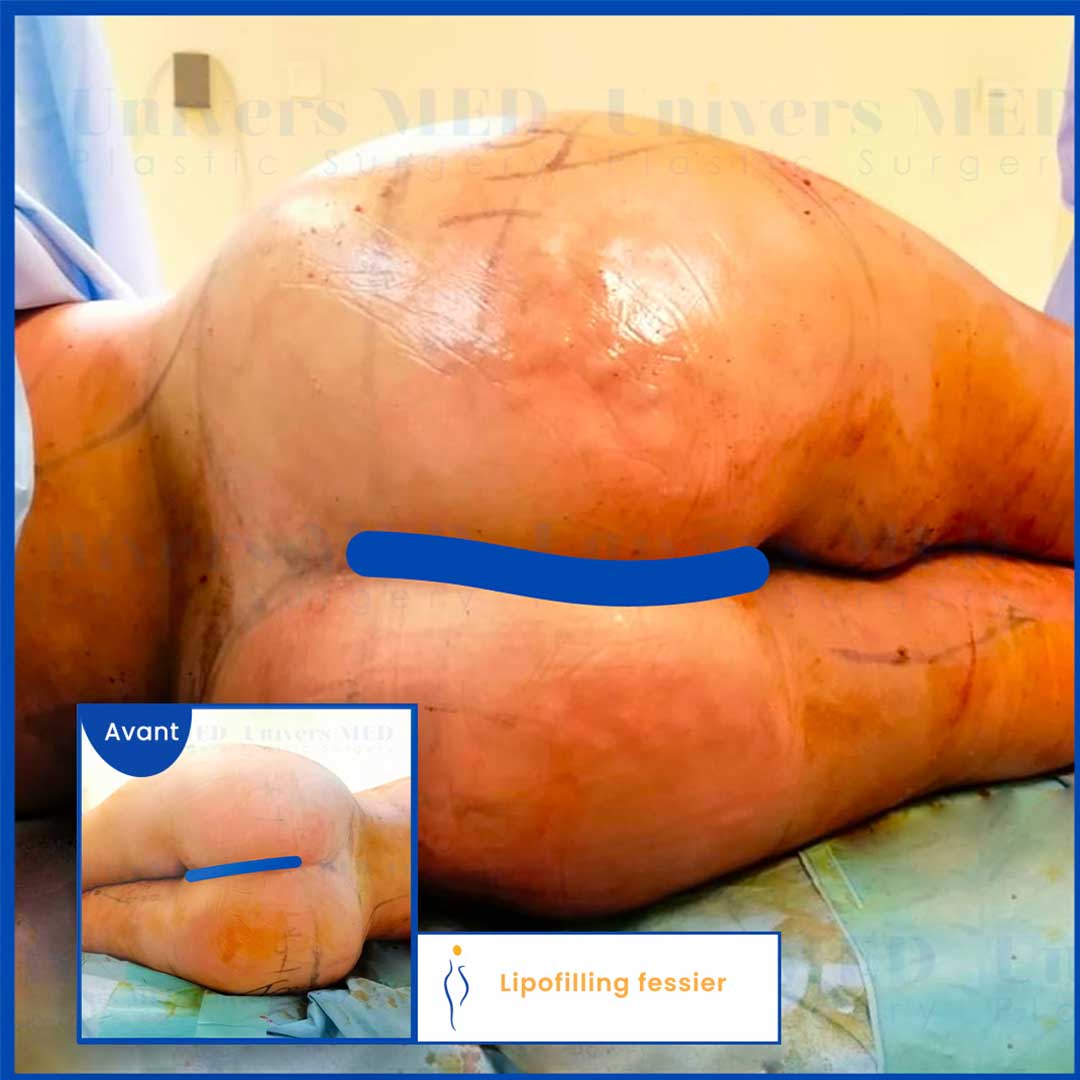 avant après augmentation des fesses par lipofilling