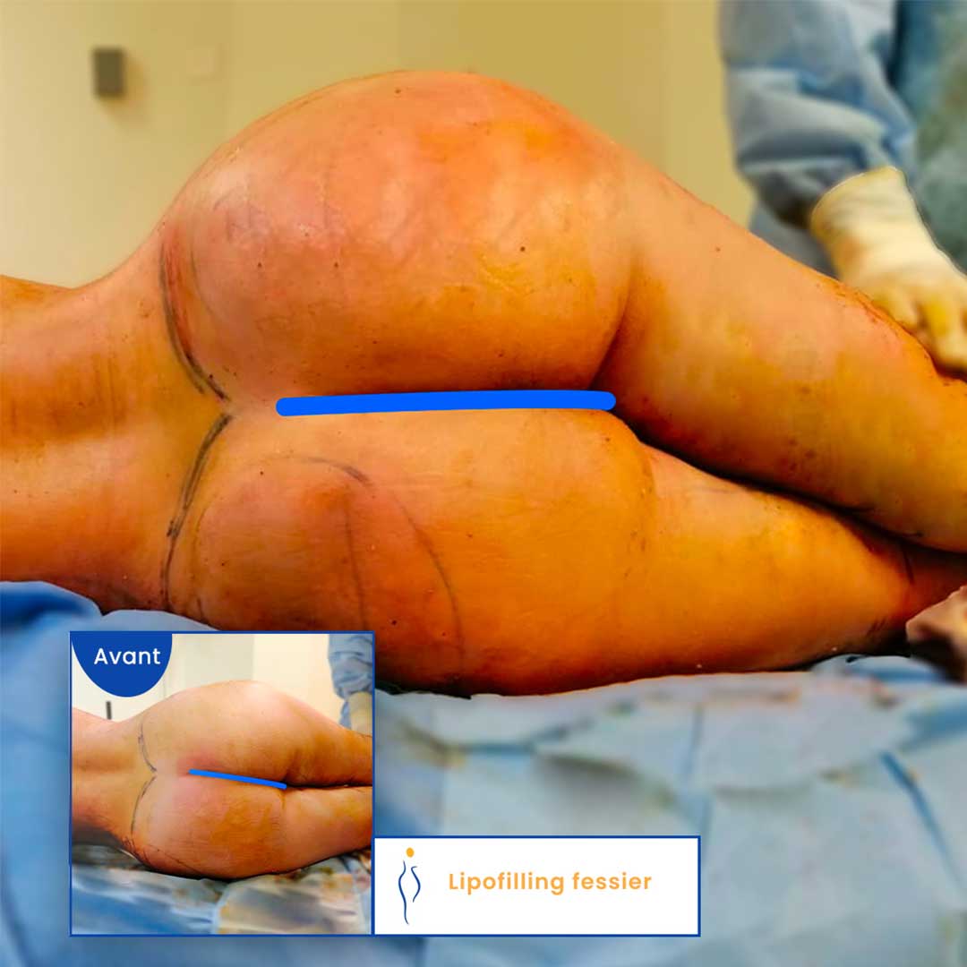 augmentation fessier avec lipofilling avant et après